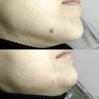 Before and after the use of the Pro-Skincell