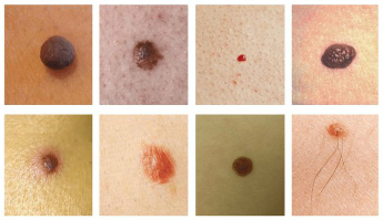 The most common blemishes on the skin are moles, and kondilomas (warts)