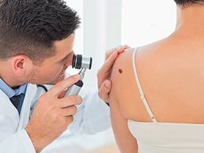 The doctor examines the papilloma about the recommendation to remove with drugs