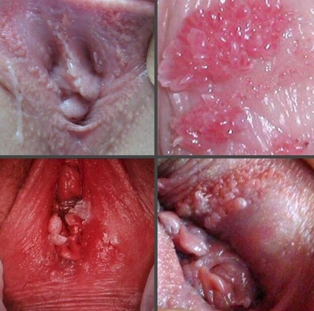 Close up picture of papilloma in vagina