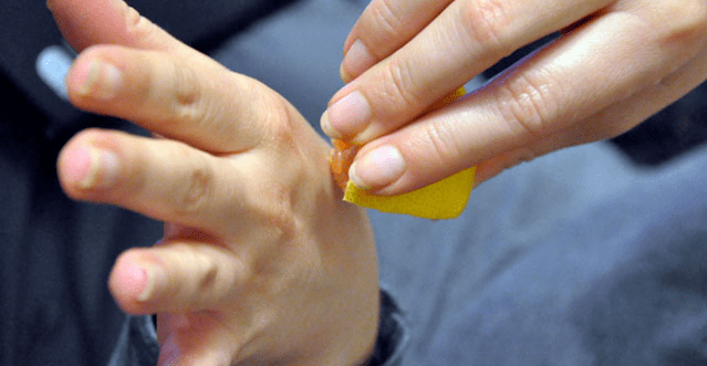 arm wart removal