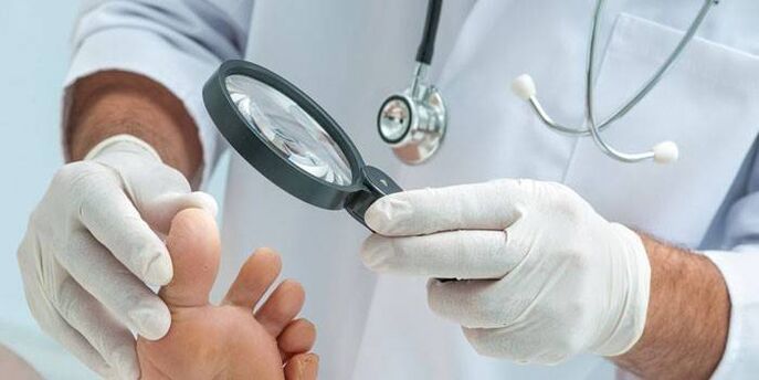 Doctor examines foot with wart on foot
