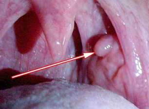 Laryngeal papilloma