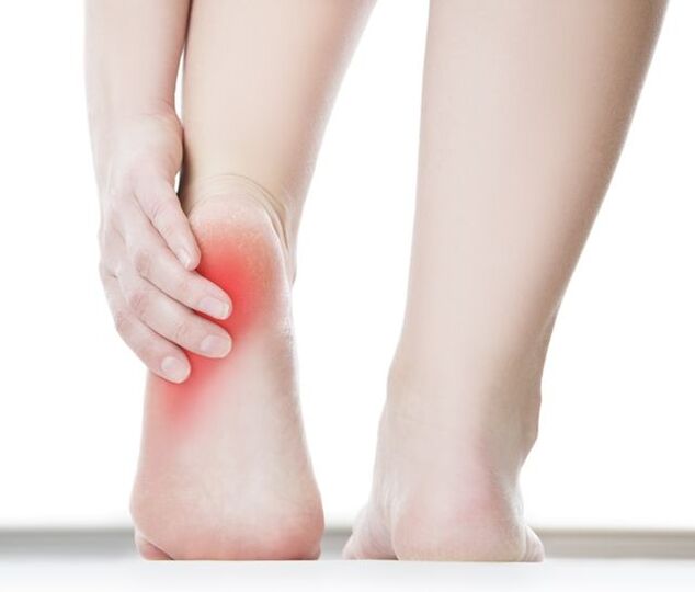 A wart on the heel causes severe pain. 