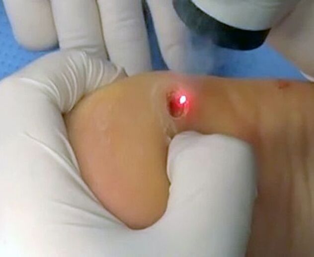 Procedure to remove warts on heels using laser