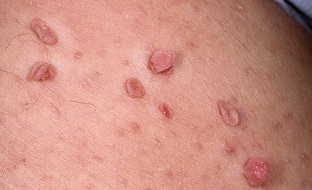 Due to the presence of papilloma on the body