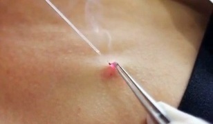 Removal of papilloma on the body with a laser