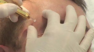 Cryodistraction - removal of papilloma with liquid nitrogen